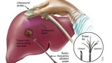 Việt Nam điều trị thành công ung thư gan bằng hạt vi cầu phóng xạ