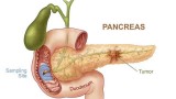 Phương pháp mới chẩn đoán bệnh ung thư tuyến tụy