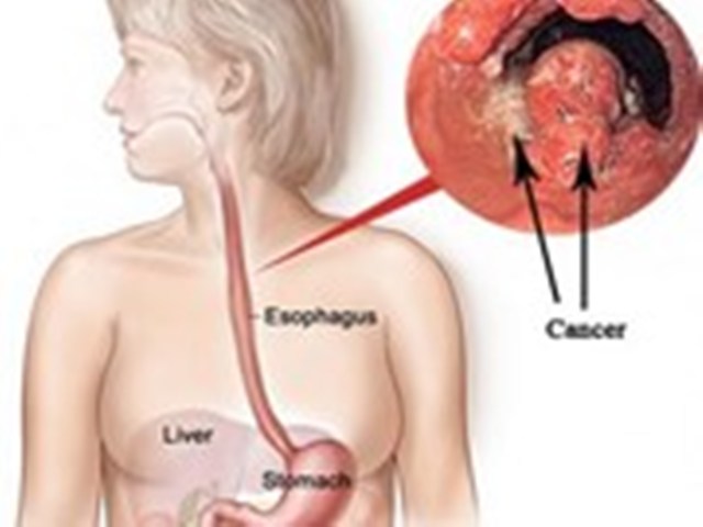 Nhật Bản công bố phương pháp mới điều trị ung thư thực quản