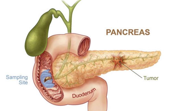 Phương pháp mới chẩn đoán bệnh ung thư tuyến tụy