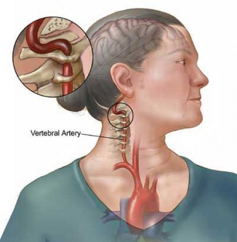 Phòng tai biến: Chú ý 5 yếu tố